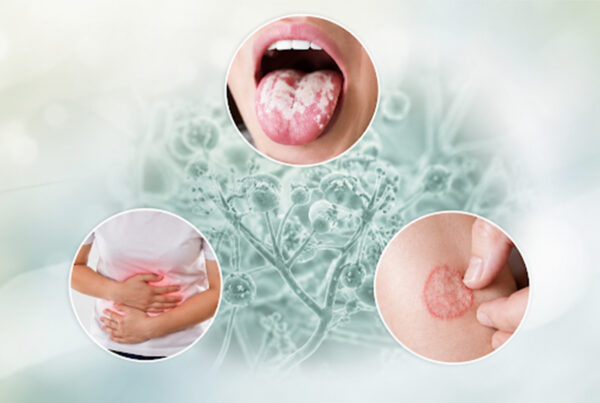 Devnyst 50,000 IU Tablet for oral, intestinal and skin fungal infection treatment