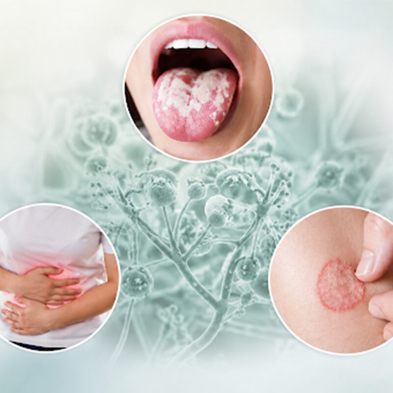 Devnyst 50,000 IU Tablet for oral, intestinal and skin fungal infection treatment