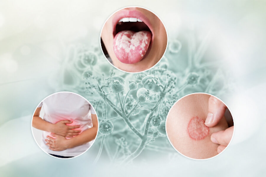 Devnyst 50,000 IU Tablet for oral, intestinal and skin fungal infection treatment