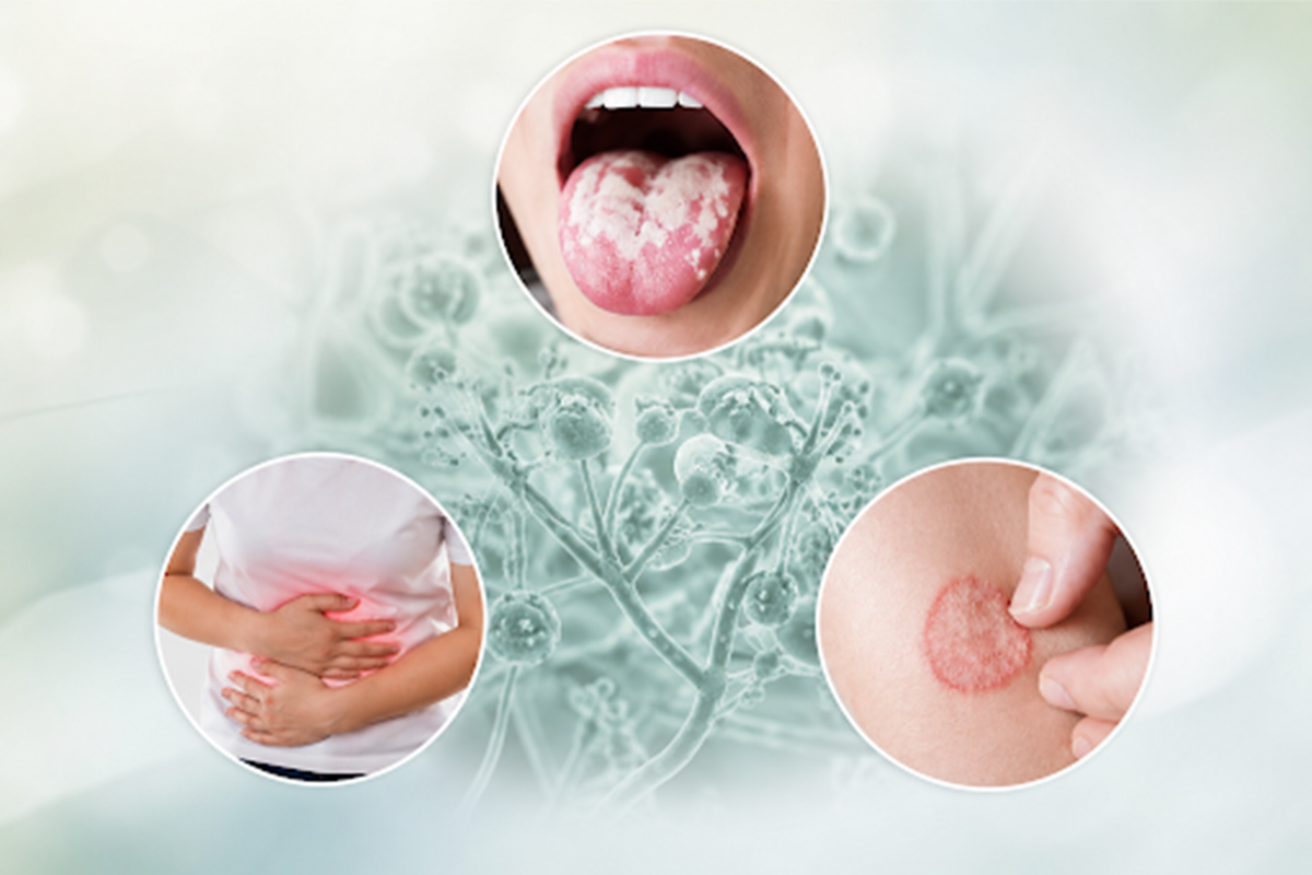 Devnyst 50,000 IU Tablet for oral, intestinal and skin fungal infection treatment